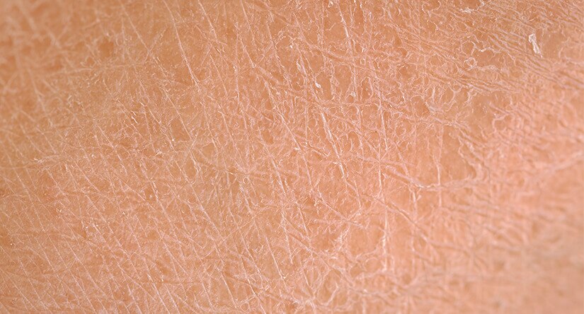 How to care for dry skin: Causes, treatment and prevention advice How to care for dry skin: Causes, treatment and prevention advice